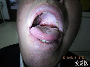 难治的口腔粘膜白斑是何物