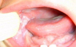 口腔粘膜科 治疗疾病详解
