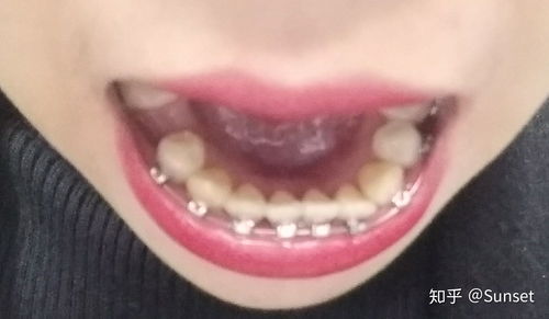 我的正畸之旅 在河源恒信口腔医院的口腔新生